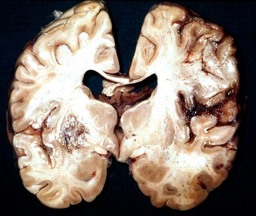cerebral aspergillosis