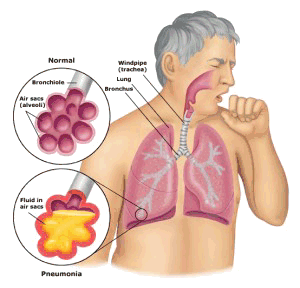 respiratory infection mold and legionella